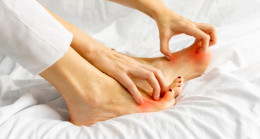 Ayak Mantarı Tedavisi